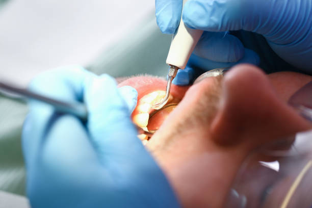 Best Emergency Wisdom Teeth Removal in St Stephen, SC