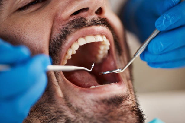 Best Emergency Wisdom Teeth Removal in St Stephen, SC